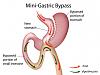 mini-gastric-bypass1.jpg